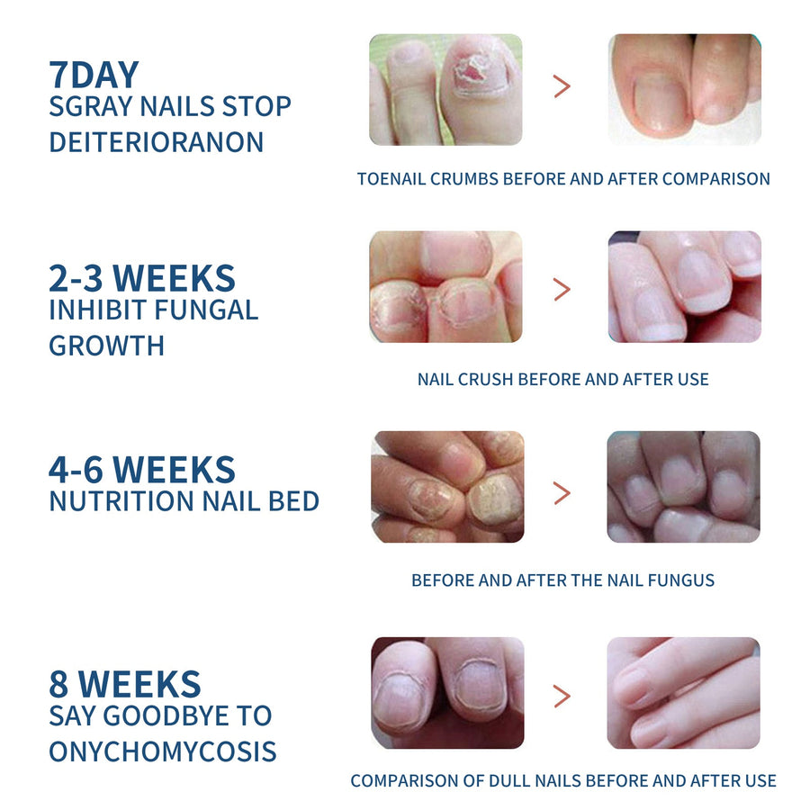 Fungal Toenail Treatment Patches — Visibly Clearer Nails