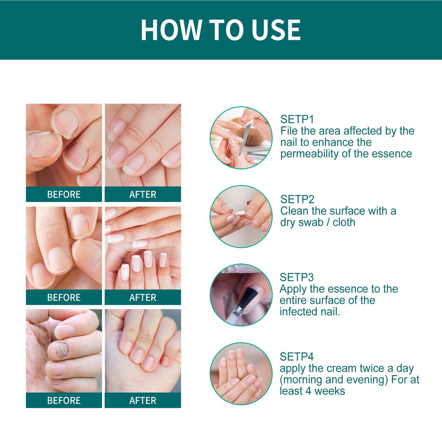 Toenail Fungus Treatment Roll-On - Visible Results in 7 Days