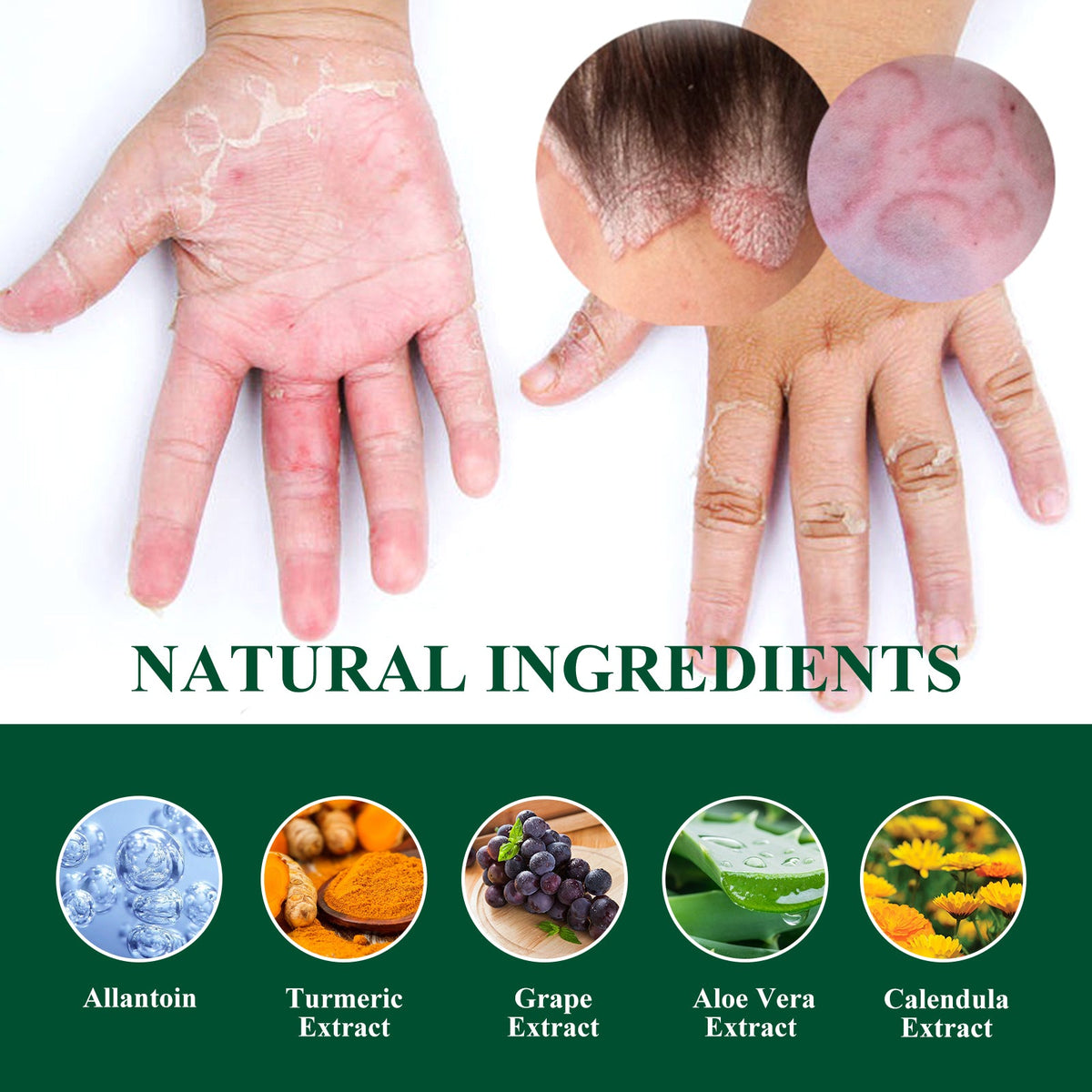 Skin Repair Cream for Shingles Itch & Rash Relief