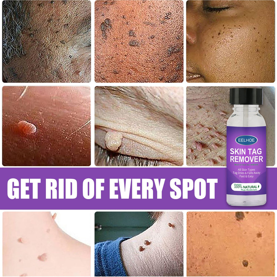 Skin Tag Remover – Natural Mole & Wart Treatment with Thuja