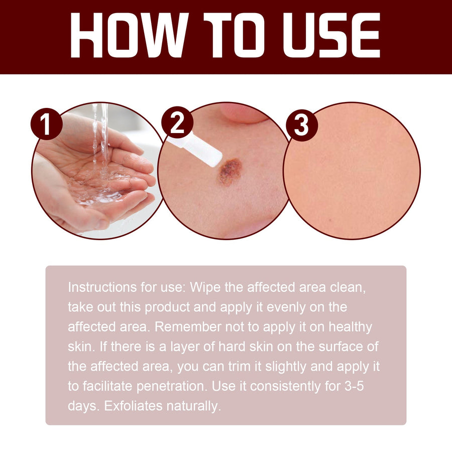 Liquid Wart Removal Pen — Flatten Skin Tags & Warts in 5 Days
