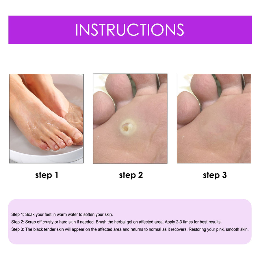 Wart & Corn Removal Liquid – Clinically Proven Botanical