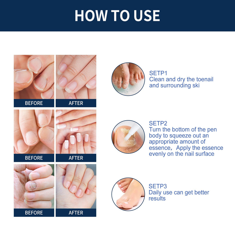 Nail Repair Essence Pen — Restores Healthy Nails from