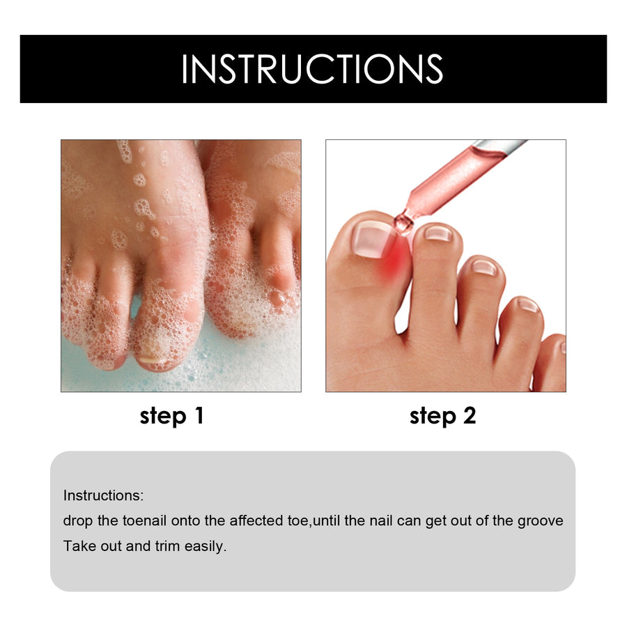 Toenail Repair Essence for Ingrown Nail Pain Relief