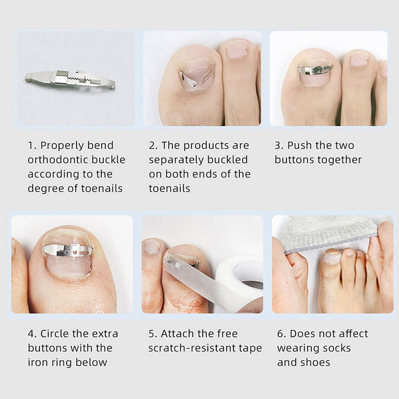Ingrown Toenail Corrector Brace, Discreet Steel Lift