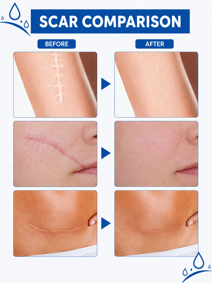 Jaysuing Scar Cream — Clinical Scar Removal Treatment