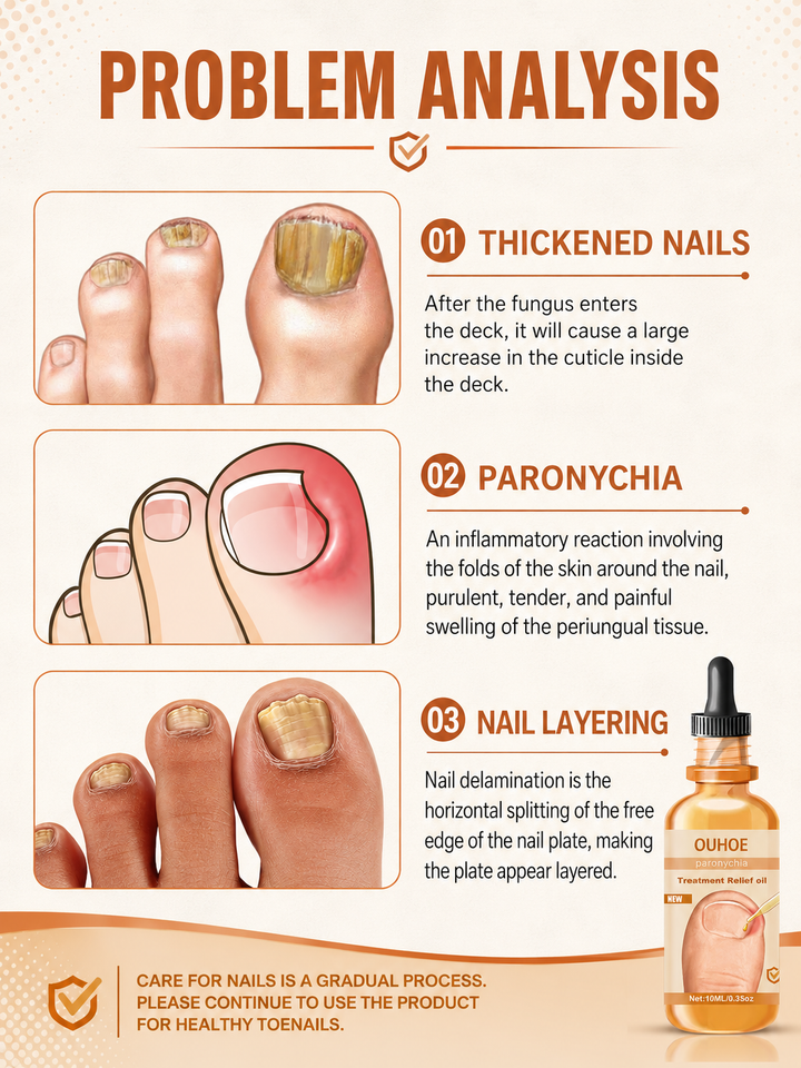 Nail Treatment Oil — Relieves In‑Growing Toenails