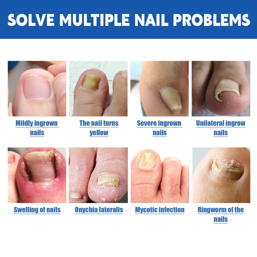 Toenail Care Patches for Targeted Nail Comfort at Home