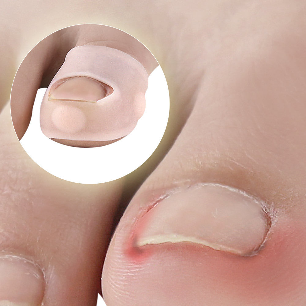 Silicone Ingrown Toenail Corrector — Painless