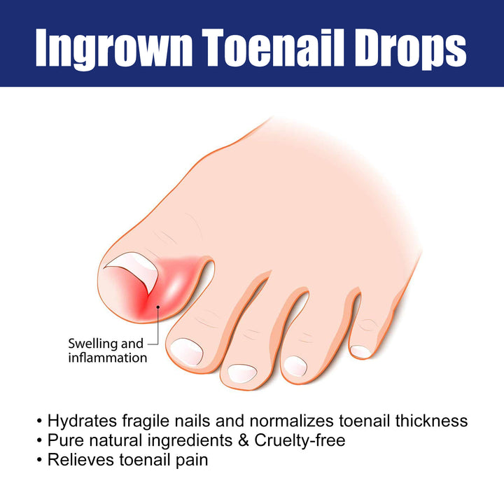 Nail Repair Solution for Gentle Ingrown Toenail Relief