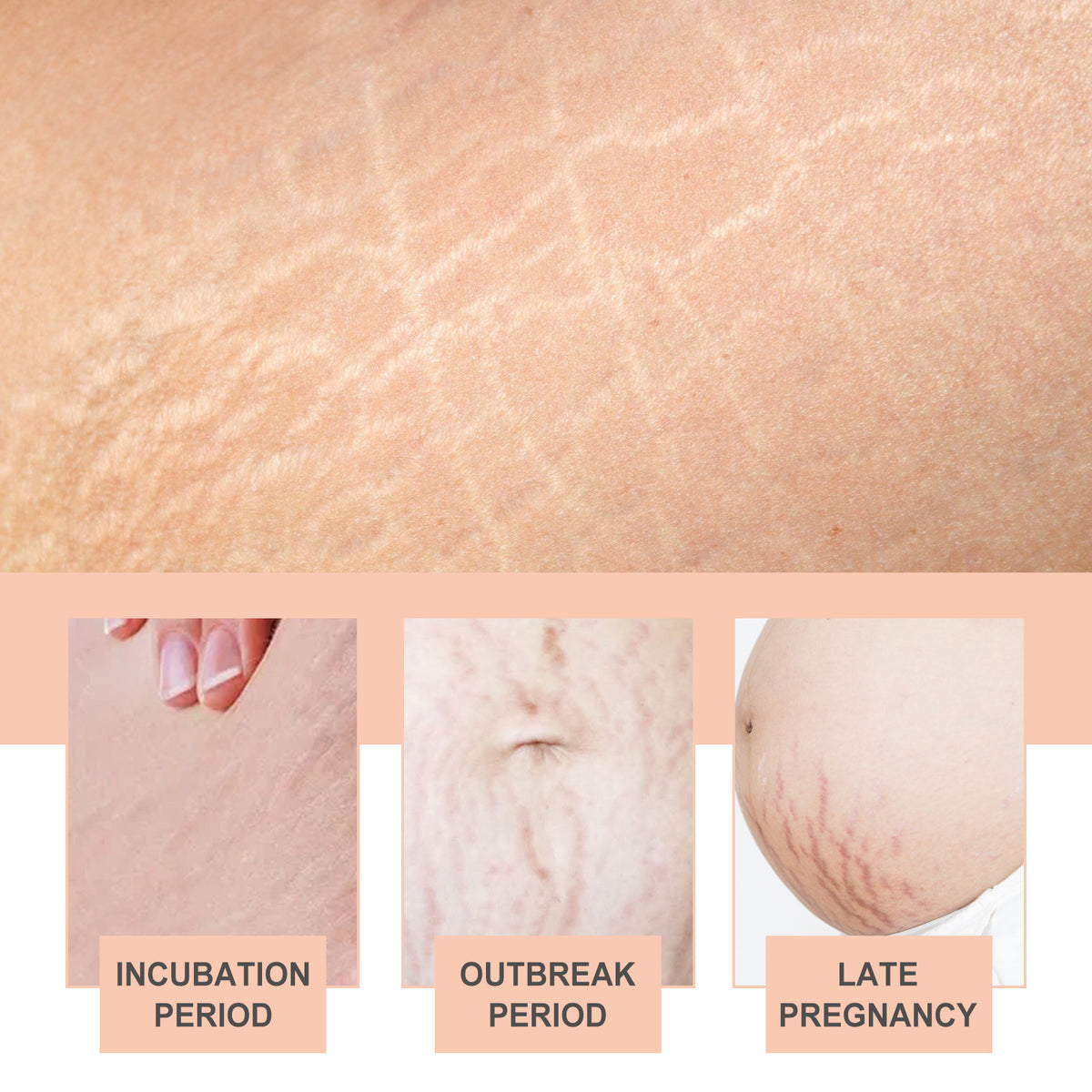 Pregnancy Stretch Mark Cream for Elasticity & Moisture