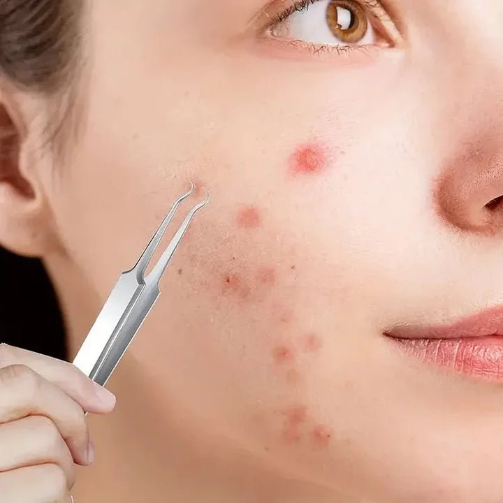 Professional Blackhead Tweezers - wanelo - store - roman