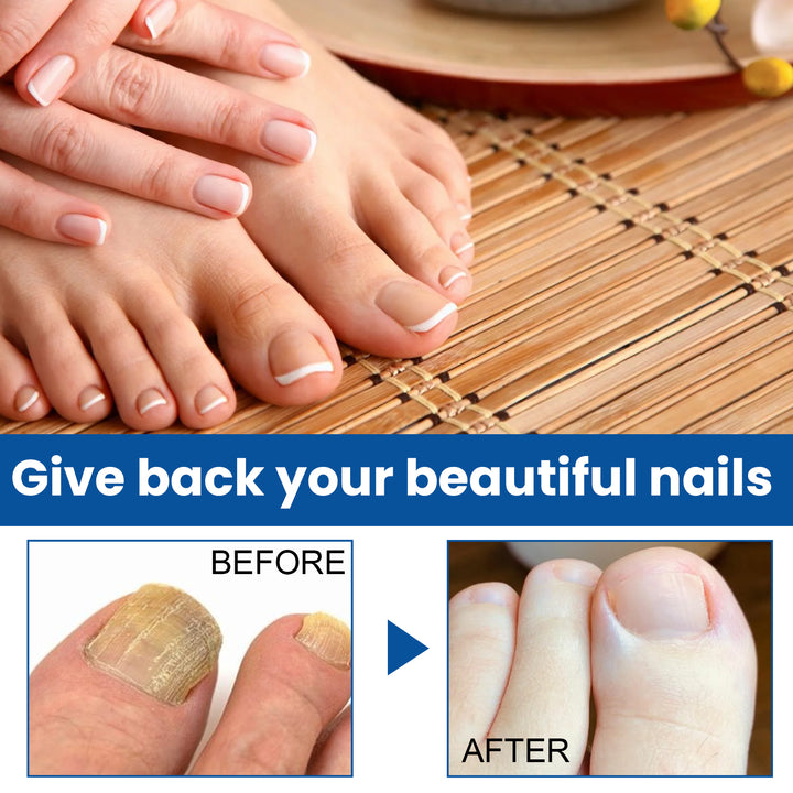 Nail Repair Treatment for Thick, Discolored Nails