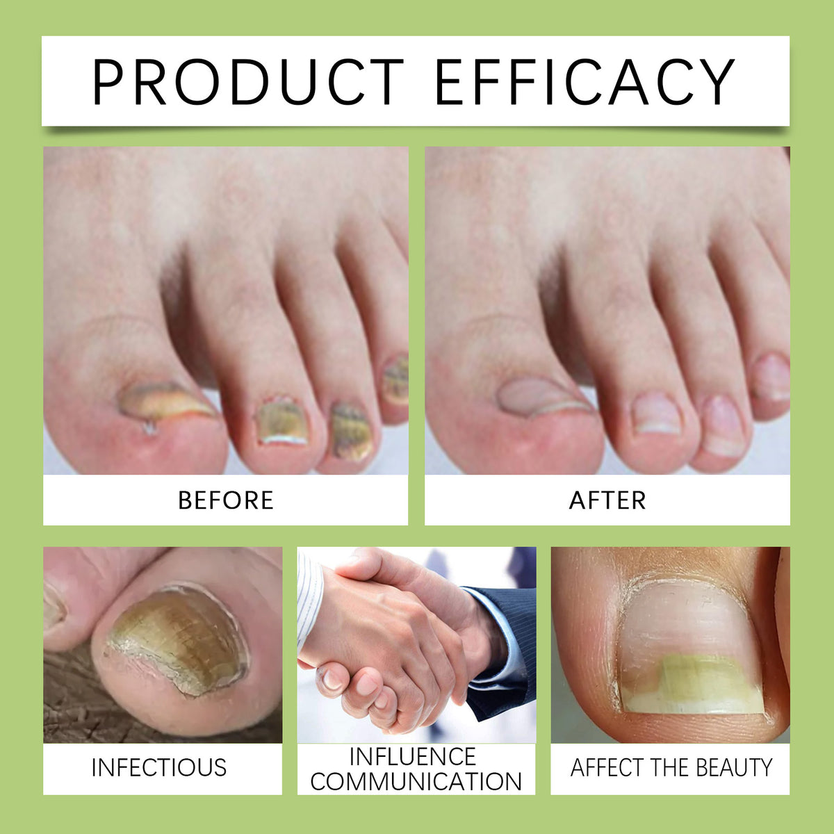 Toenail Fungus Care Set for At-Home Nail Grooming