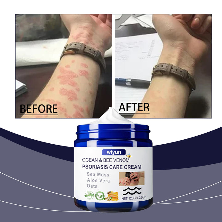Bee Venom Psoriasis Care Cream for Dry, Itchy Skin