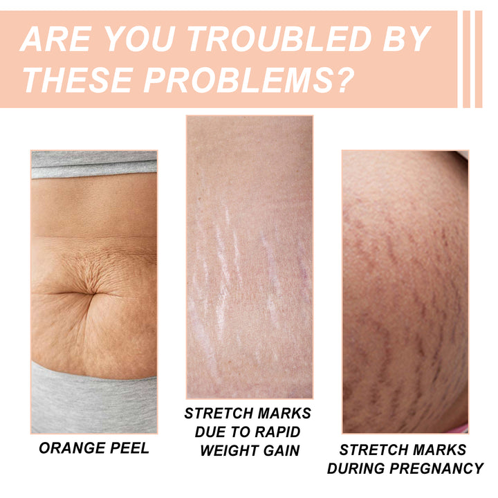 Pregnancy Stretch Mark Cream for Elasticity & Moisture