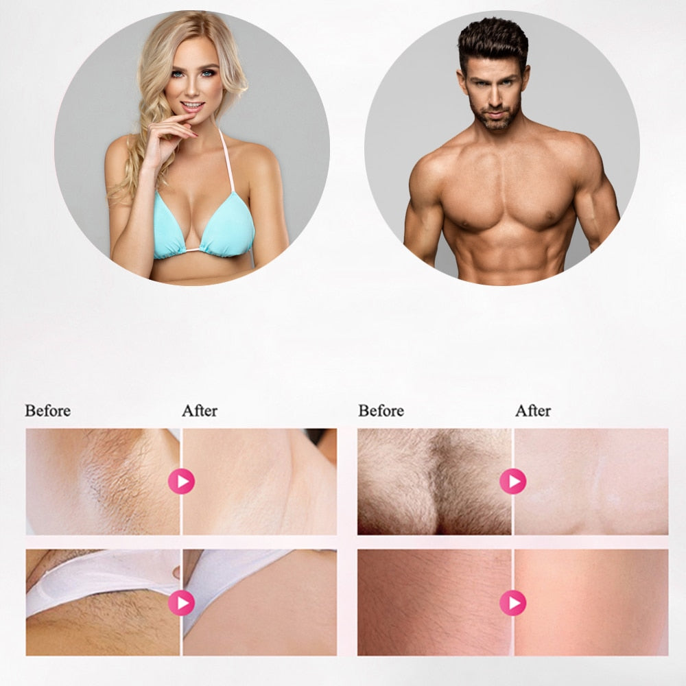 IPL Hair Removal Handset — Permanent Reduction with 5