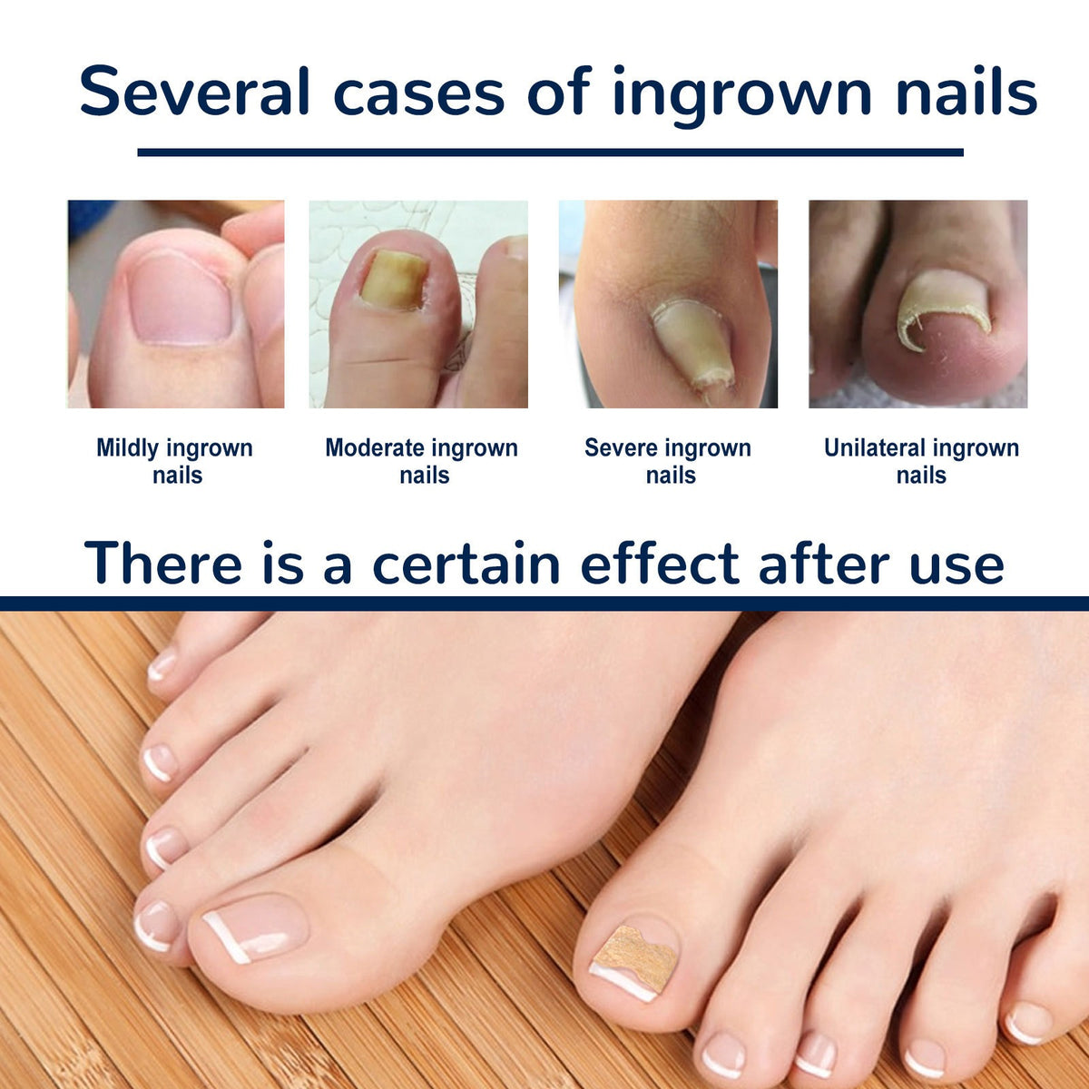 Toenail Correction Patches — Gentle Ingrown Relief