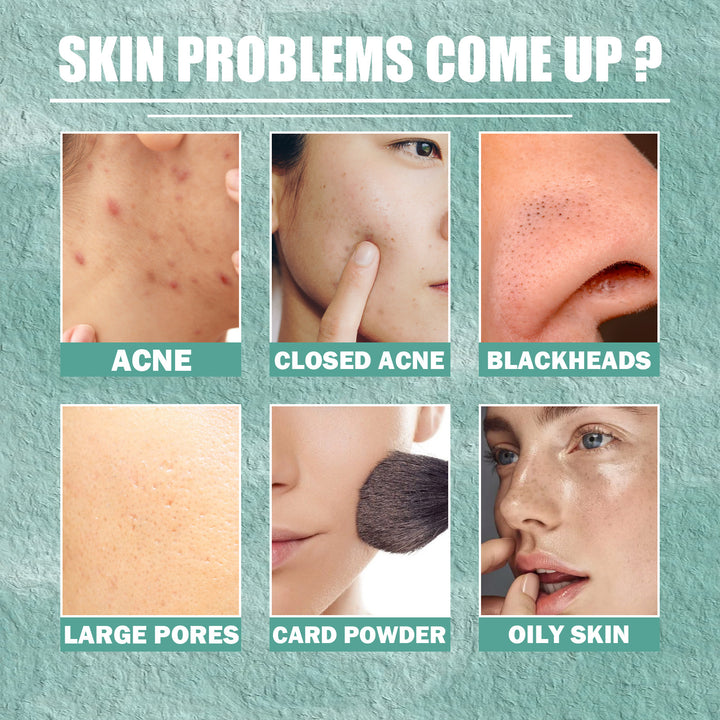 Cystic Acne Cream With Salicylic Acid For Clogged Pores