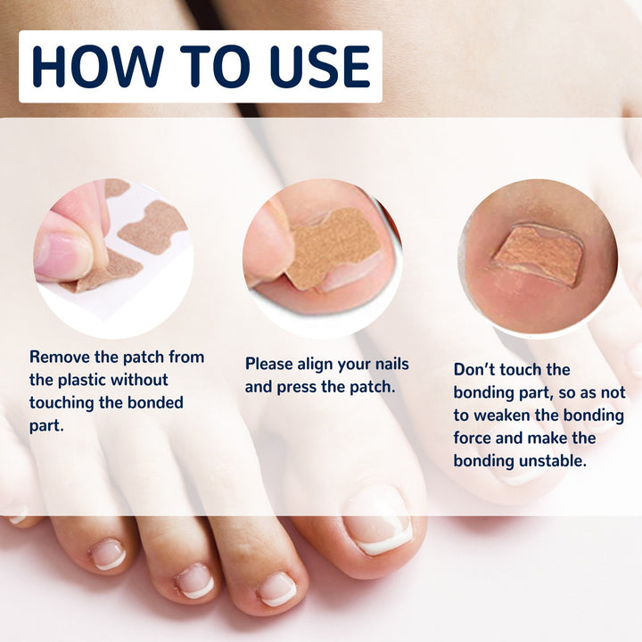 Toenail Correction Patches — Gentle Ingrown Relief