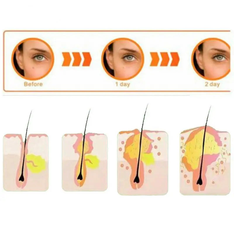 Pimple Patches, Invisible Acne Spot Covers, 36-Piece