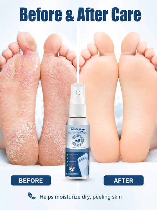 Athlete’s Foot Spray - Natural Relief for Itchy, Gray Nails
