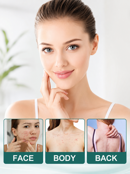 Star Acne Patches 112-Count — Color-Coded Spot Treatment