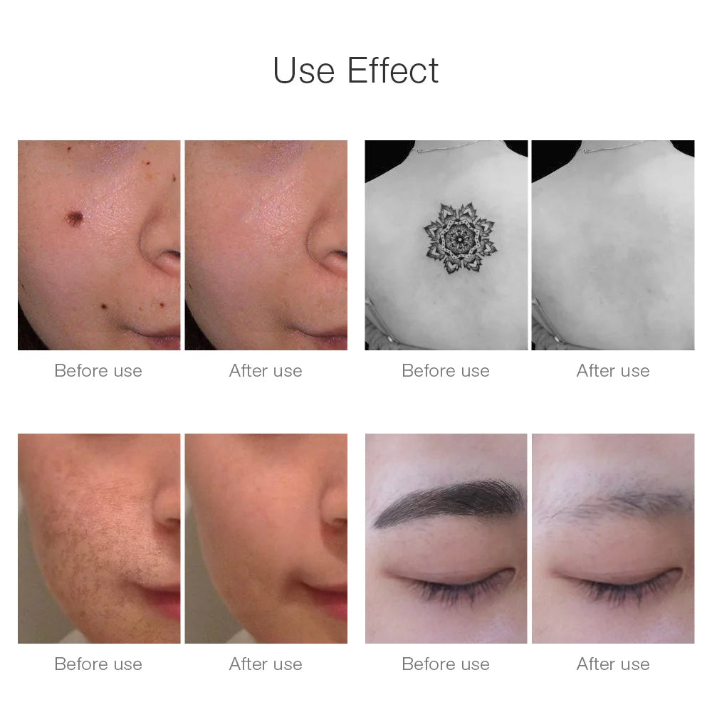 Picosecond Laser Removal Pen — Fade Dark Spots & Tattoos