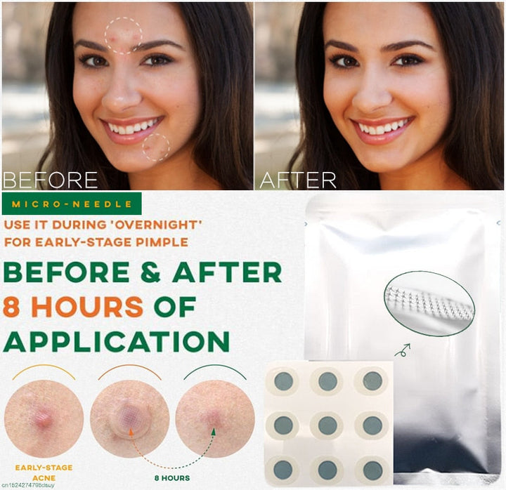 Microneedle Pimple Patch — Clear Pimples in 8 Hours