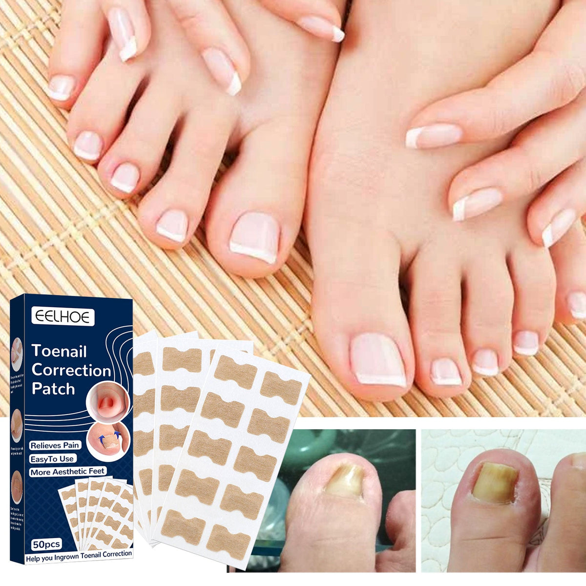 Ingrown Toenail Correction Patch Kit - Pain Relief 50pk