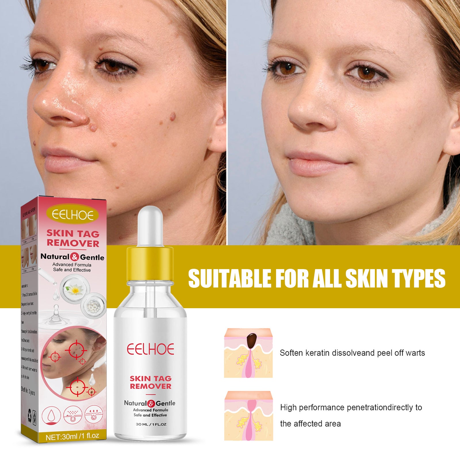 Educational infographic showing types of moles, skin tags, and conditions the product treats with clinical close-up imagery