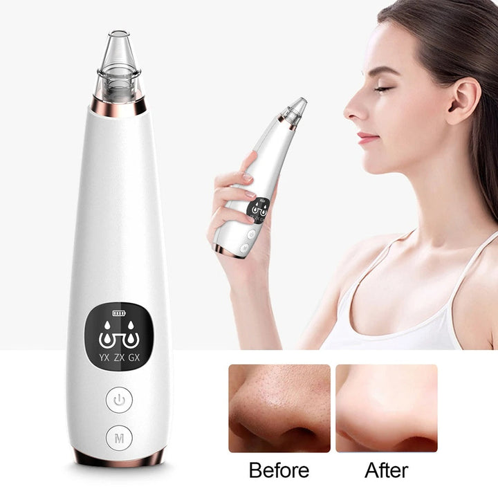 Blackhead Remover Vacuum — Professional Pore Cleansing at Home