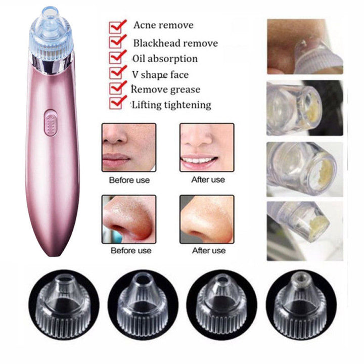 Pore Vacuum Blackhead Remover — Clearer Skin in 2 Weeks
