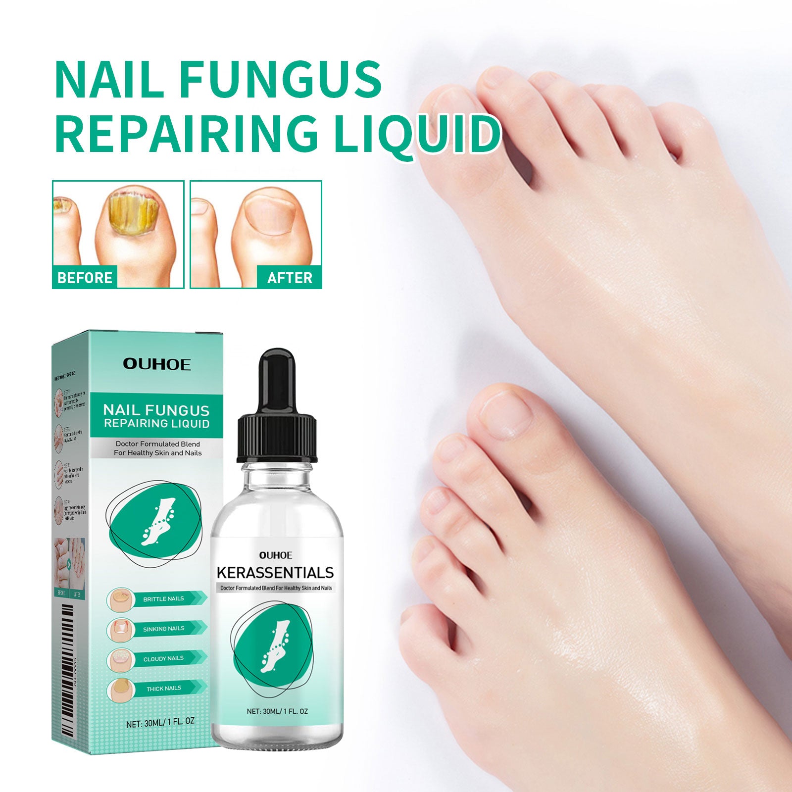 Four-stage progression of fungal nail treatment from heavily infected yellow nail to completely clear healthy nail