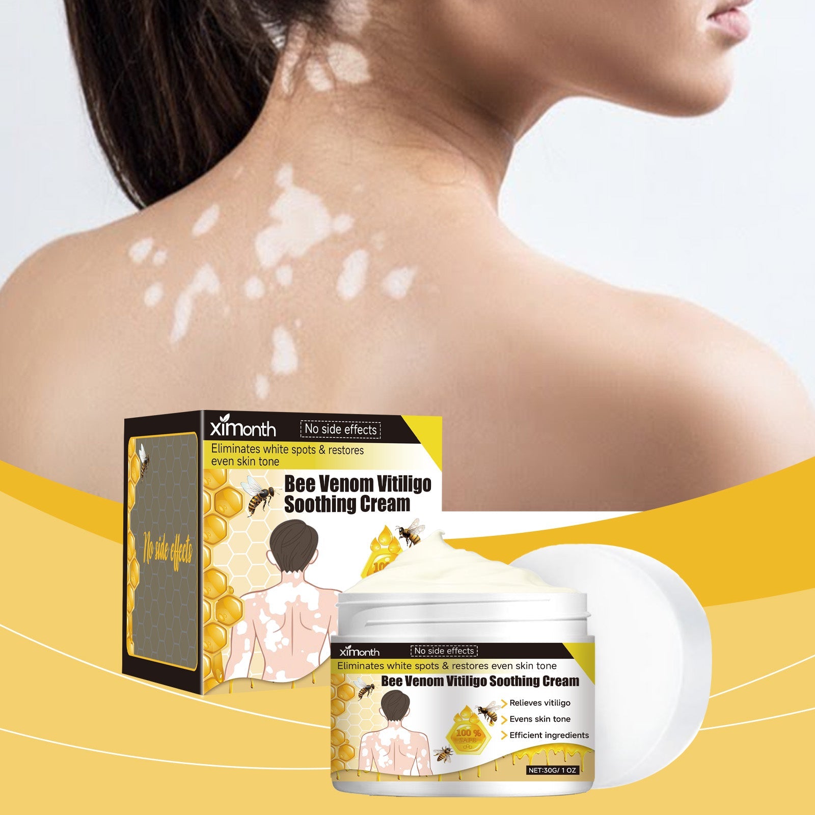 Woman with back showing vitiligo patches alongside product jar with yellow banner listing benefits: deep nourishment, white spot repair, soothing and moisturizing, refreshing and non-greasy