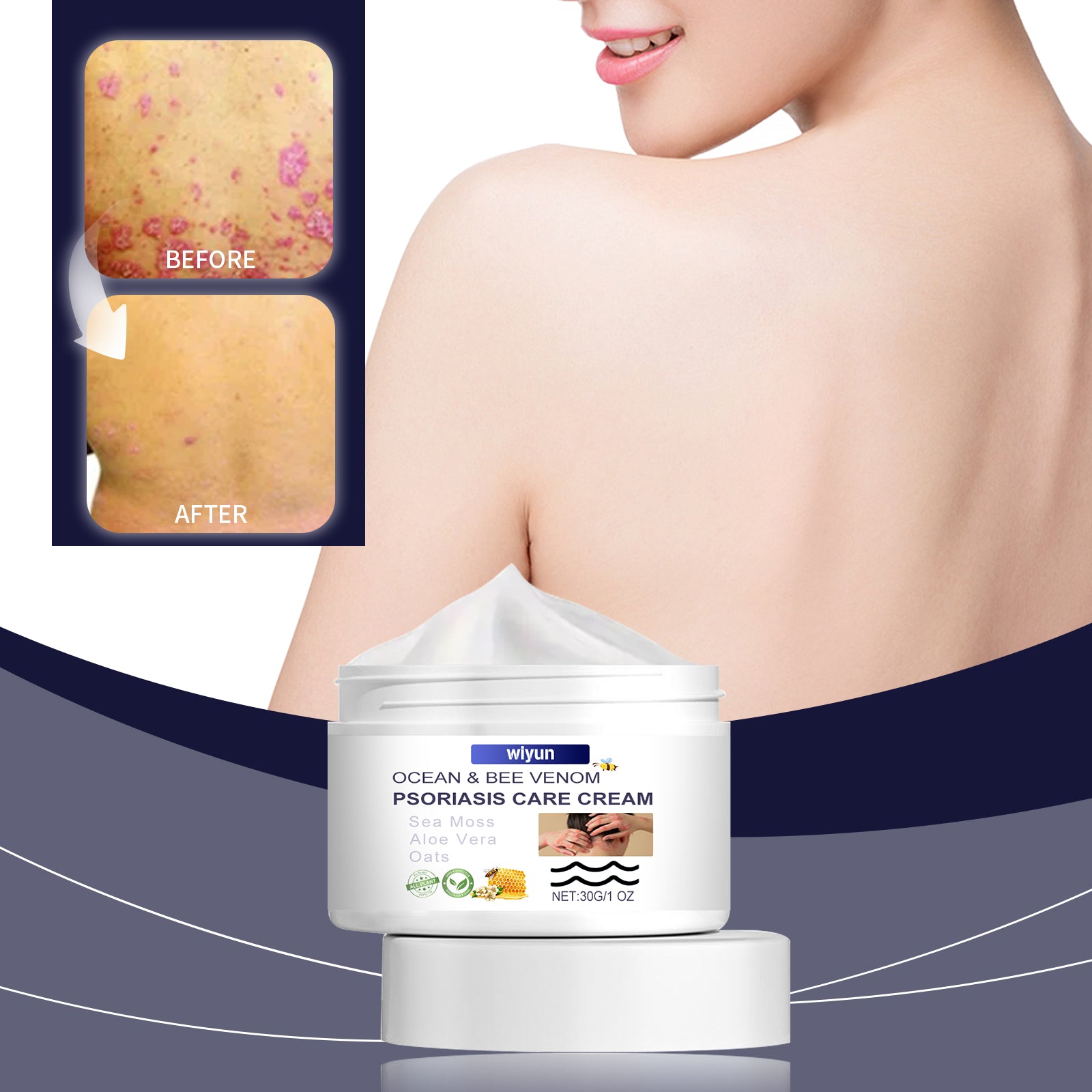 Woman's bare shoulders and neck with healthy glowing skin, hand touching face gently, product tagline 'Ocean Bee Venom Psoriasis Care Cream' below