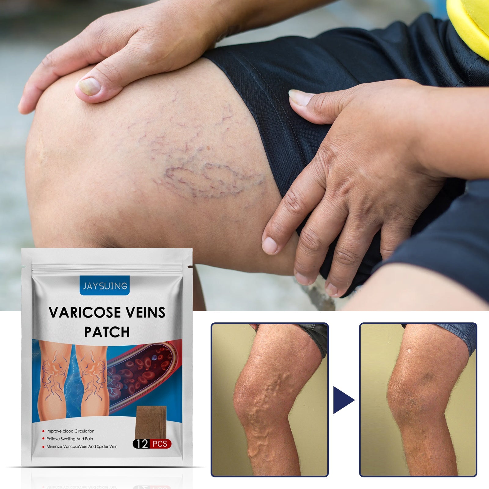 JAYSUING Varicose Veins Patch box showing 12-piece pack with anatomical illustrations of varicose veins and blood circulation