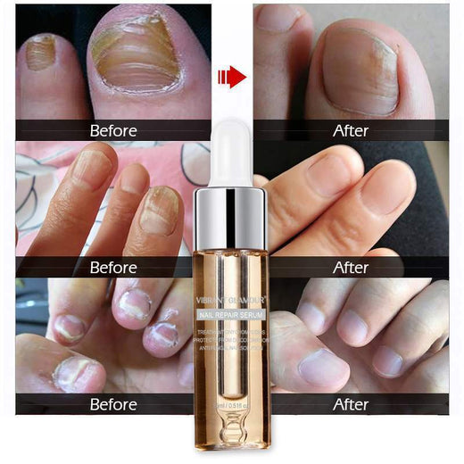 Fungal Toe Nail Treatment for Smoother, Healthier Nails