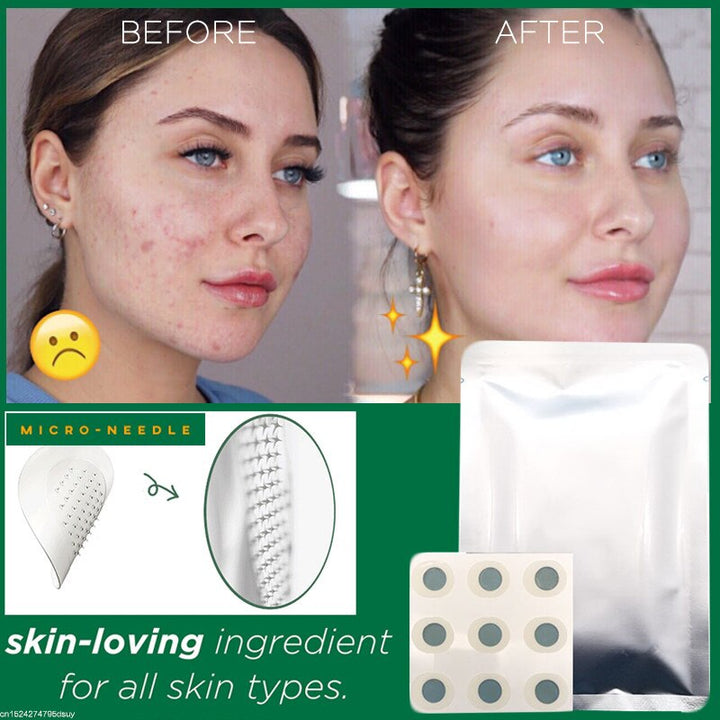 Microneedle Pimple Patch — Clear Pimples in 8 Hours