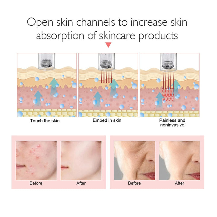 Microneedling Pen — Reduce Acne Scars & Fine Lines at Home