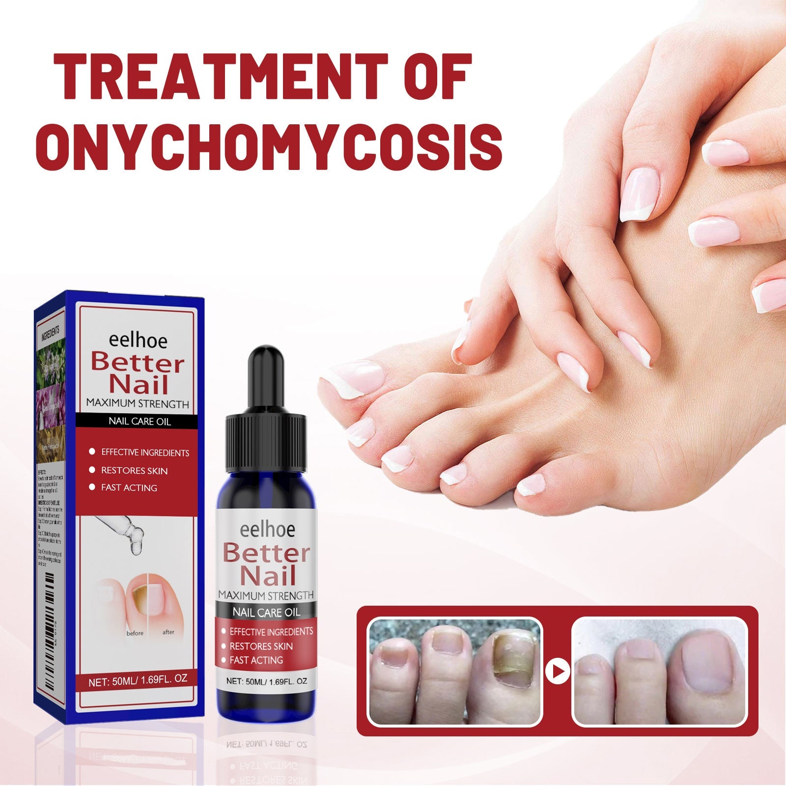 Healthy manicured hands with pale pink nails displayed prominently; before/after comparison of severe fungal nails healing; product packaging and bottle shown at left with 'Treatment of Onychomycosis' headline
