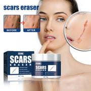 Before and after scar comparison with close-up magnified view of stretch mark reduction on woman's skin