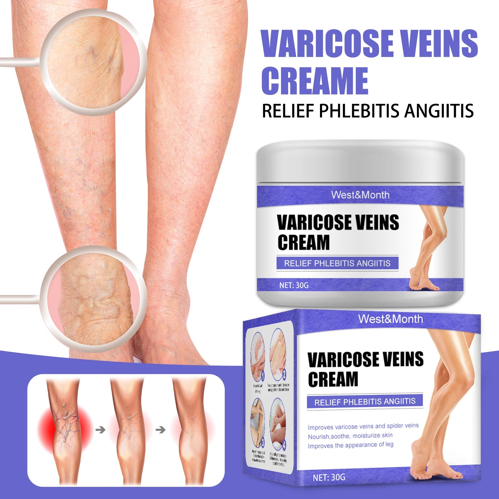 Detailed leg imagery with circled close-ups of varicose veins and progression timeline showing treatment results