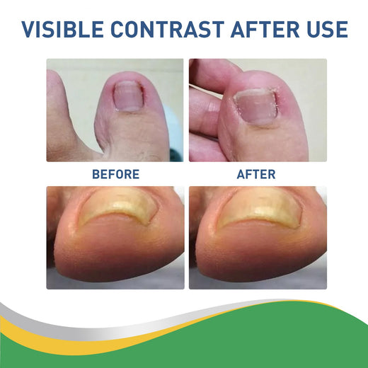 Toenail Correction Patches for Curved, Ingrown Nails