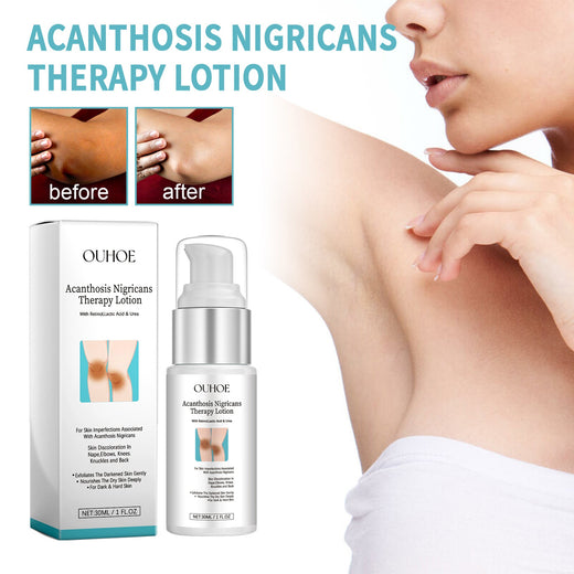 Acanthosis Nigricans Therapy Lotion for Dark Skin Patches