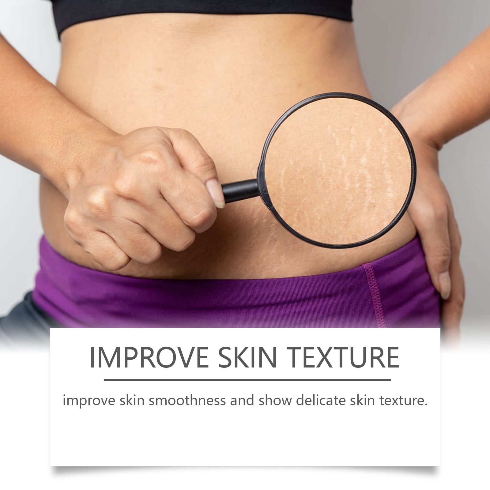Split before/after comparison showing stretch mark reduction on stomach area