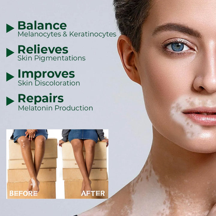 Vitiligo Care Cream for a More Even-Looking Skin Tone