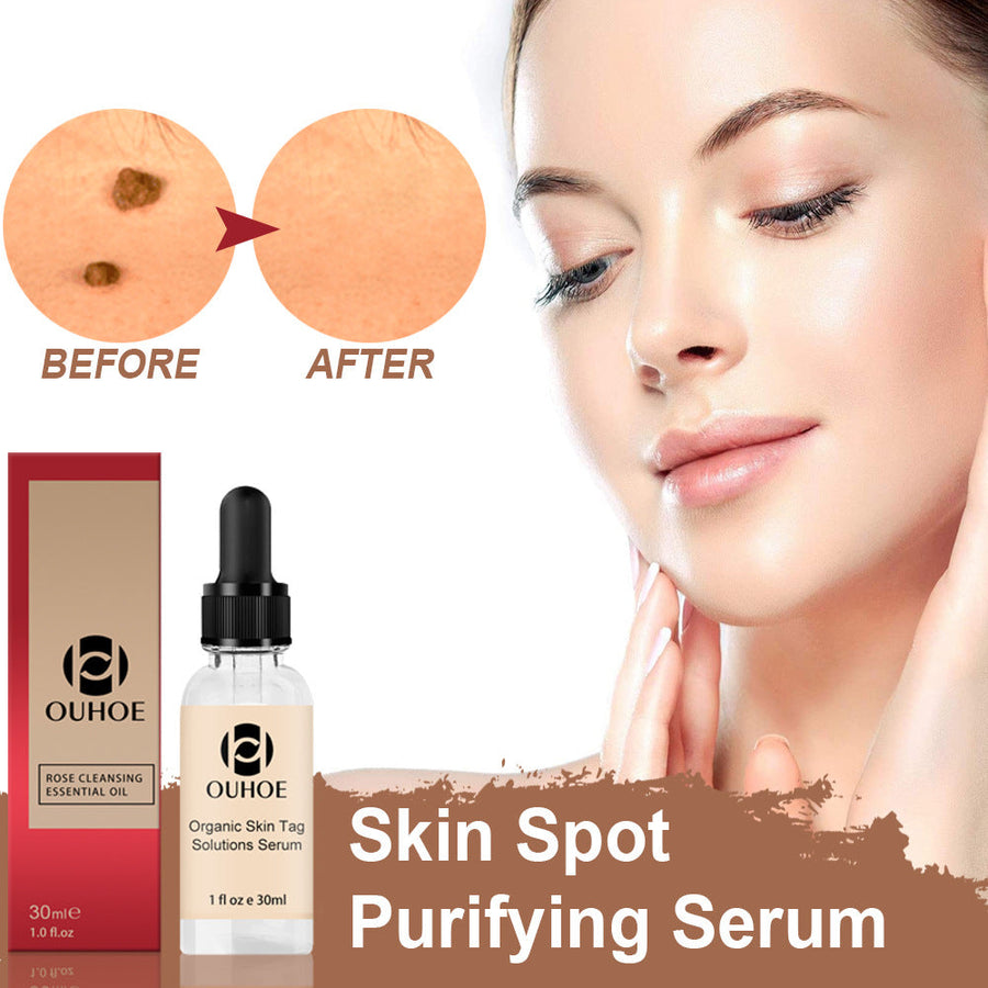 Removing Nevus Liquid Removing Nevus Cream Repair Removing N
