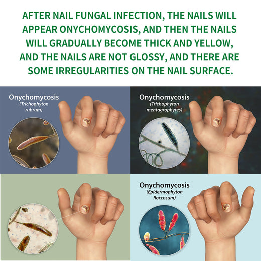 Nail Fungus Treatment With Ginger Plant-Based Formula