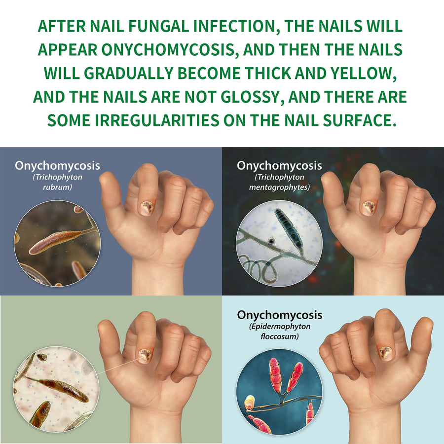 Nail Fungus Treatment With Ginger Plant-Based Formula